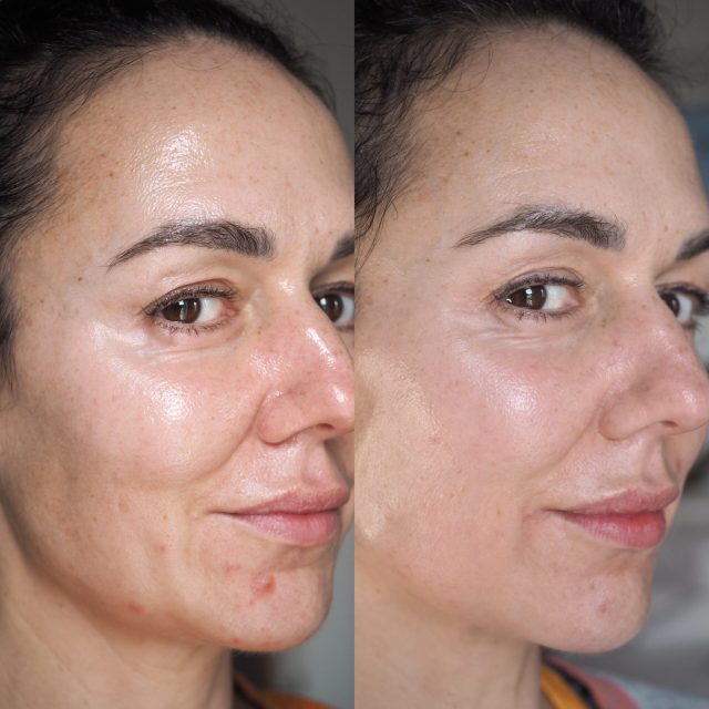 CurrentBody Skin LED Light Therapy Mask Before and After